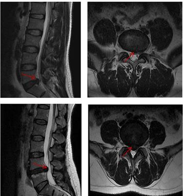 Degree centrality-based resting-state functional magnetic resonance imaging explores central mechanisms in lumbar disc herniation patients with chronic low back pain